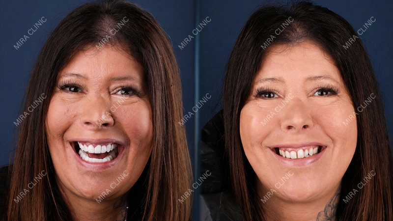 bite alignment before and after 